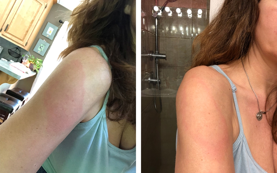 Reaction site to Covid Vaccine